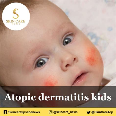Atopic Dermatitis Kids