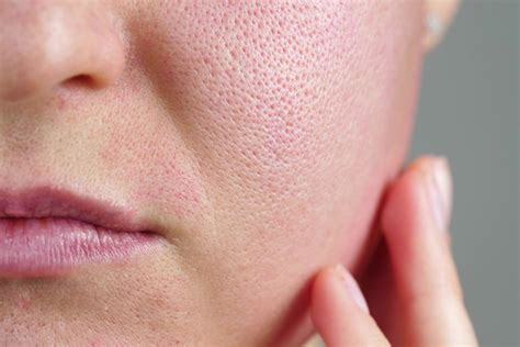 How To Get Rid Of Open Pores Naturally At Home