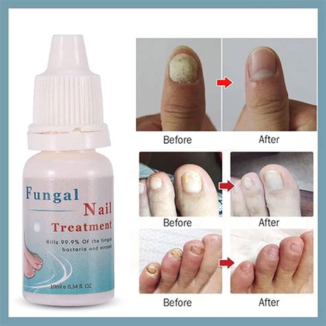 Details 153 Bacterial Nail Infection Treatment Vn