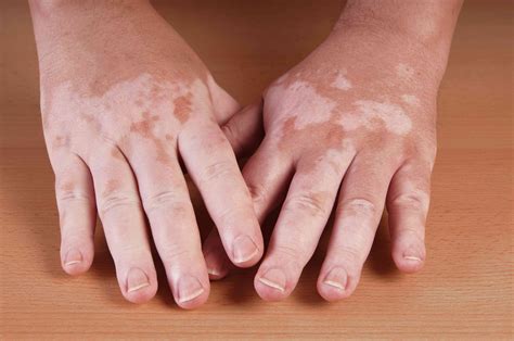 Vitiligo Types Causes And Treatment