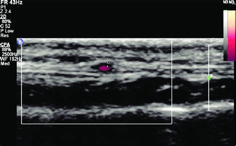 Doppler Ultrasound Scan Of The Temporal Artery The Classical Halo