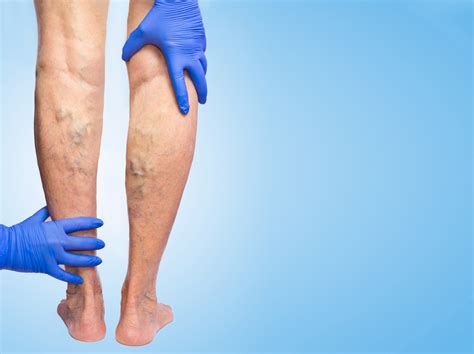 Varicose Veins Frequently Asked Questions The Vein Center Of Maryland
