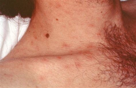 Hiv Rash On Chest Current Health Advice Health Blog Articles And Tips