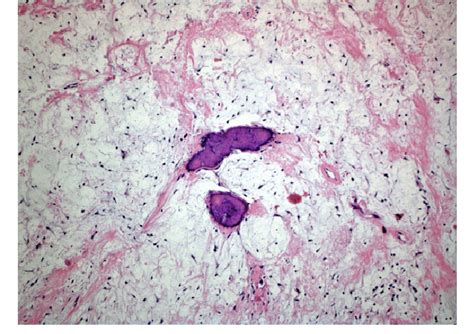 Odontogenic Myxoma Showing Stellate And Spindleshaped Mesenchymal Cells
