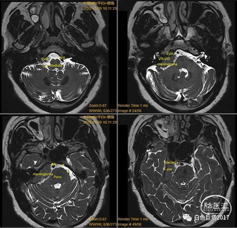 乙状窦后入路切除右侧桥脑小脑角区 岩斜脑膜瘤 脑医汇 神外资讯 神介资讯