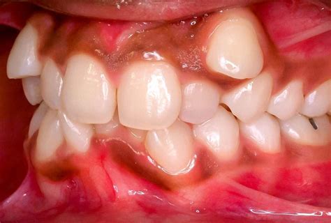 Malocclusion Misaligned Teeth Studio Dentaire