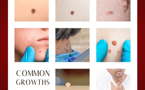 How Are Common Growths Treated Asa Dermatology Allentown Lehigh Valley