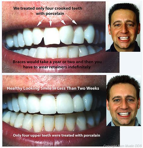 Keep watching to see a straightening crooked teeth braces time lapse and some crooked teeth before/after results that were achieved using our high tech solution for remote cosmetic orthodontic treatment. How To Fix Crooked Teeth Without Braces At Home - Homemade ...