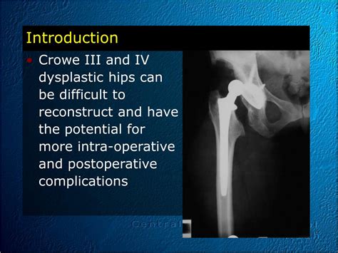 Ppt Congenital Hip Dislocation Powerpoint Presentation Free Download Id1847736