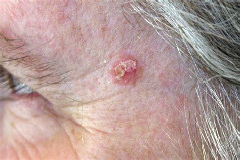 How To Recognise Actinic Keratosis Emergency Live