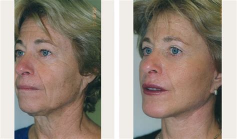 Dermabrasion Before And After Dr Thomas Loeb