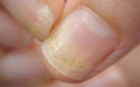 What Nail Disorders Say About Your Health Free Malaysia Today Fmt