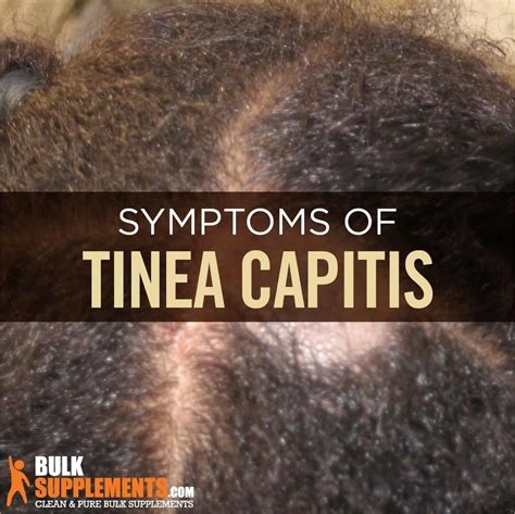 Tablo Read Tinea Capitis Ringworm Of The Scalp Causes Symptoms
