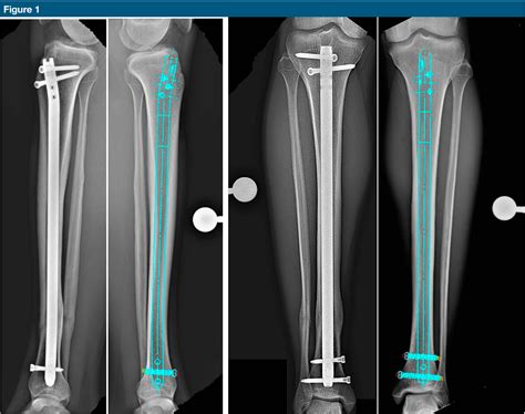 Figure 1 From Preoperative Evaluation Of Intramedullary Tibial Nail