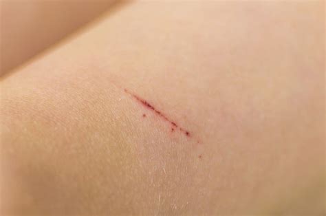 10 Symptoms And Treatments For Cat Scratch Disease Health And Detox