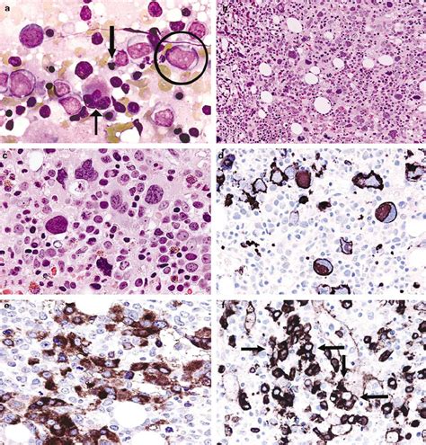 Acute Panmyelosis With Myelofibrosis A Bone Marrow Biopsy Touch