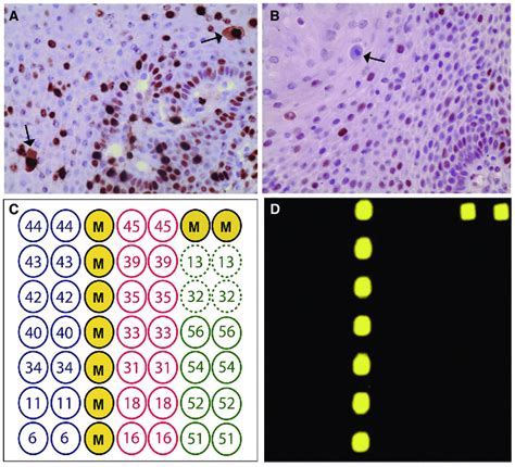 Immunohistochemical Results Of Ki 67 And P53 Ki 67 Was Immunoreactive