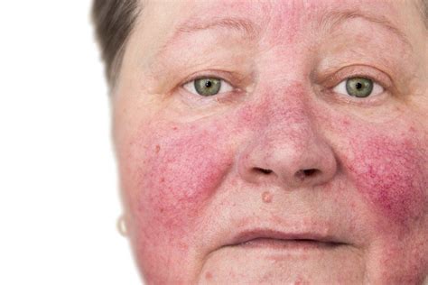Tetracyclines in acne vulgaris and rosacea (including rosacea keratitis); Feuermal | Rosazea, Rosacea behandlung, Akne