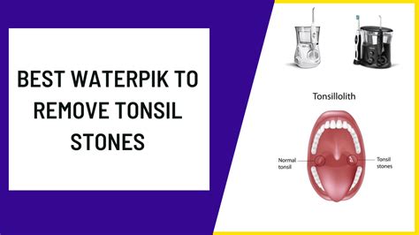 3 Best Waterpik To Remove Tonsil Stones