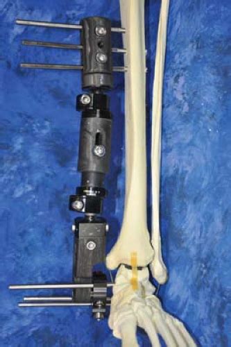 External fixation is a surgical treatment wherein rods are screwed into bone and exit the body to be attached to a stabilizing structure on the outside of the body. Stepwise Approach to Uniplane, Biplane, Delta, and Hybrid ...