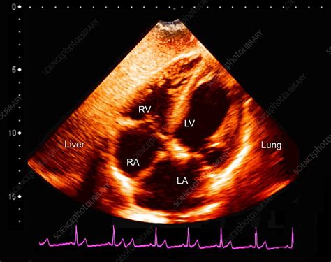 Normal Heart Ultrasound Scan Stock Image C048 0782 Science Photo