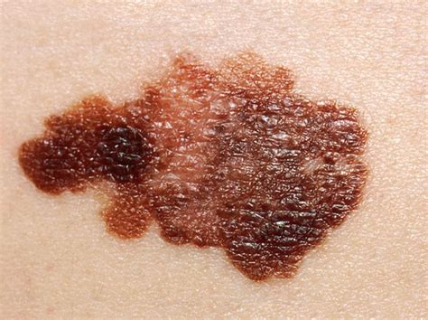 Does Methotrexate Increase Risk For Cutaneous Malignant Melanoma In