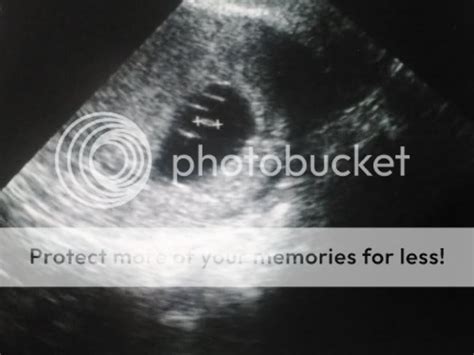 Does This Look Like A Missed Miscarriage Pictures Babycenter