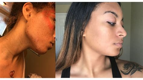 How I Cleared My Acne Without Going Vegan Youtube