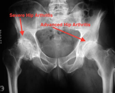 Arthritis Knee And Hip Website