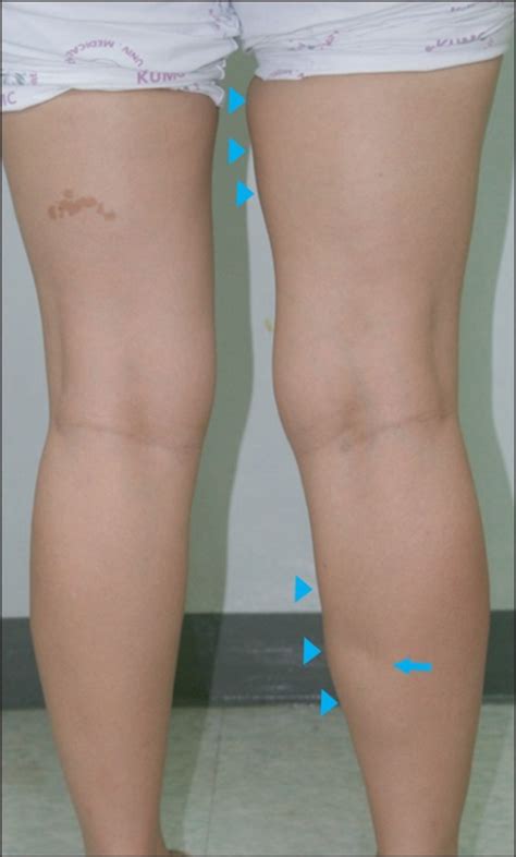 Figure 1extensive Intramuscular Venous Malformation In The Lower