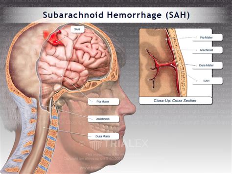 Subarachnoid Hemorrhage Sah With Inset View Of The Layers
