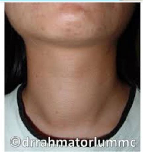 Thyroid Head And Neck Thyroid Anatomy
