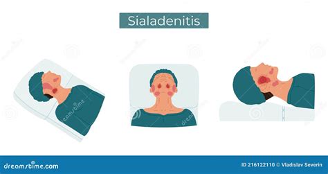 Sialadenitis A Person With Inflamed Salivary Glands Stock Vector