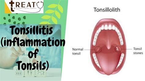 Tonsillectomy Endoscopic Surgery I Tonsil Stone Removal Itonsils