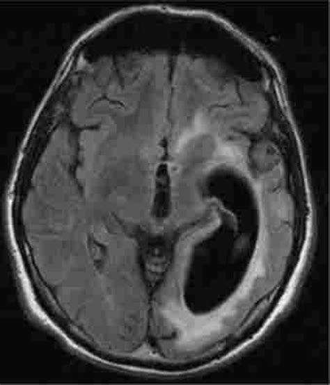 Mri Showing Ballooning Of The Left Ventricle Midline Shift Over 11mm