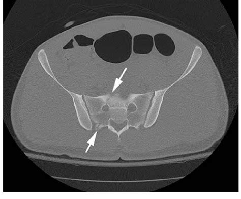 A Ct Scan Shows A Right Sacral Fracture Delineated By Arrows