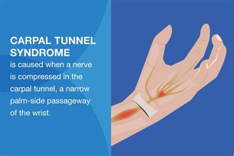 5 Carpal Tunnel Relief Products You Need At Work