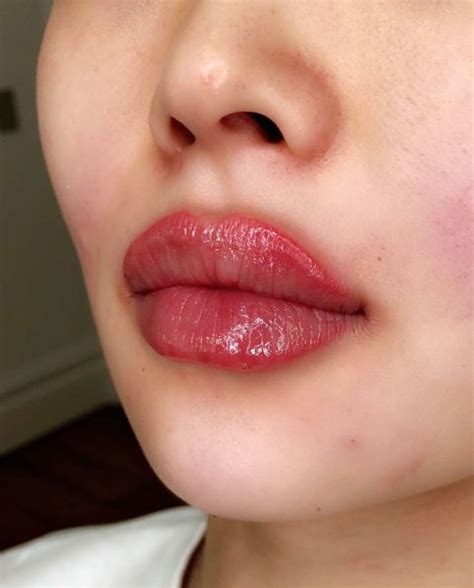 Russian Lips Best Clinic Sydney For Dermal Fillers