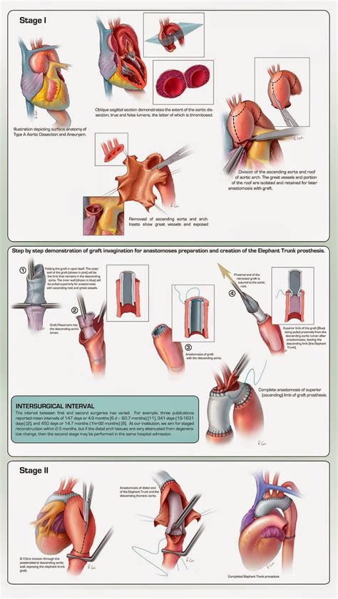 On the left is an anatomy diagram of the internal organs of a female elephant. Corl Medical Media: The Elephant Trunk Procedure for ...