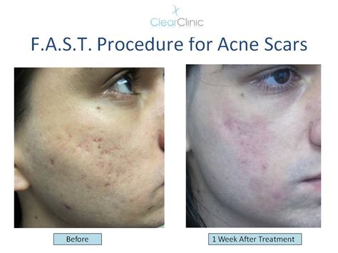 Fast Acne Scar Treatment New Laser Treatment For Acne