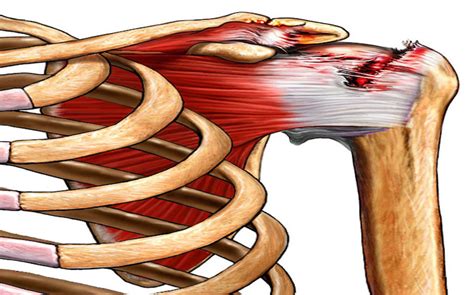 Damage to the rotator cuff tendons can develop. Rotator cuff repair in patients over 70 years of age ...