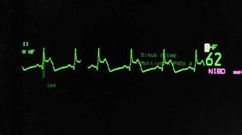 St Elevation On The Monitor Lead On An Ecg Monitor Youtube