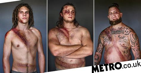 Car Crash Survivors Show Scars From Seatbelts That Saved Their Lives