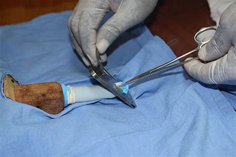 Male Circumcision Procedure