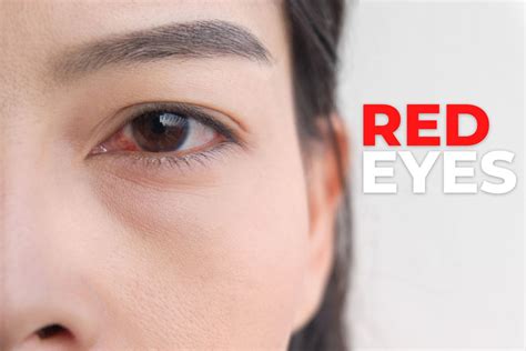 The 10 Most Common Reasons For Red Eyes Ezontheeyes