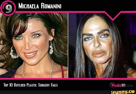Top Botched Plastic Surgery Fails Before And After Toe