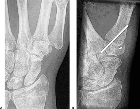 Traumatic Thumb Carpometacarpal Joint Dislocations Journal Of Hand