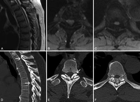Repeated Recurrence Of Thoracic Spine Stenosis Following Decompression Alone For Ossification Of