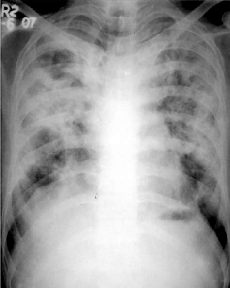Chest Radiograph Pa View After Chest Tube Removal Showing Fully