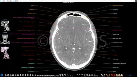 Ct Scan Brain Anatomy Anatomy Of Head Ct Scan Normal The Brain On Ct